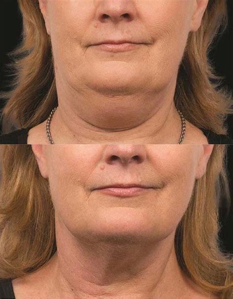 coolsculpting chin brisbane|Best Double Chin Treatments In Brisbane .